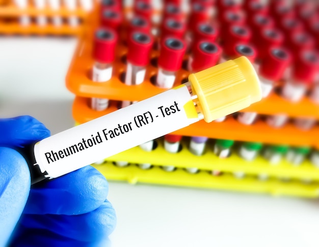 Foto campione di sangue test rf (fattore reumatoide) o ra (artrite reumatoide).