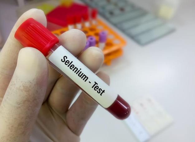 Blood sample for Selenium test to diagnose selenium deficiency or toxicity for malnutrition