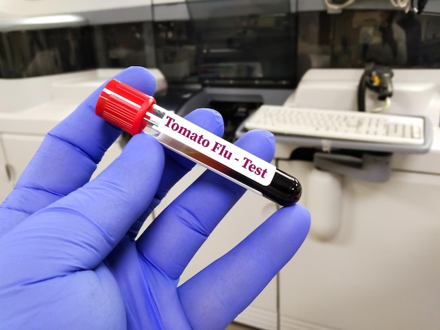 Blood sample for Tomato flu or tomato fever test. It's characterised by fever, joint pain, red rash