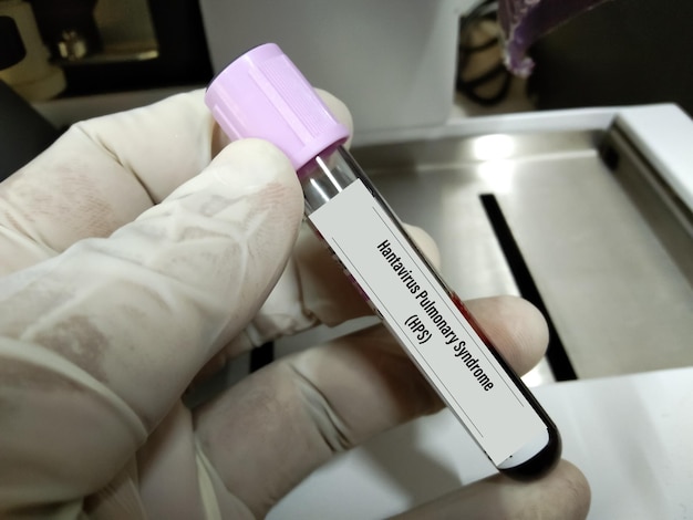 Пробирка с пробой крови для теста на хантавирусный легочный синдром (HPS). Его также называют потливостью.