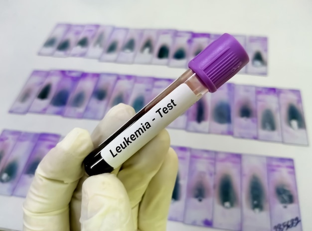 Blood sample tube for leukemia cells test