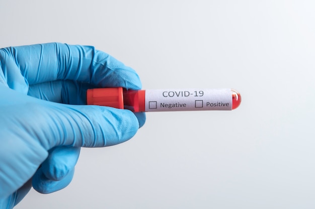 Blood sample tube positive with COVID-19 virus or novel coronavirus 2019 found in Wuhan, China