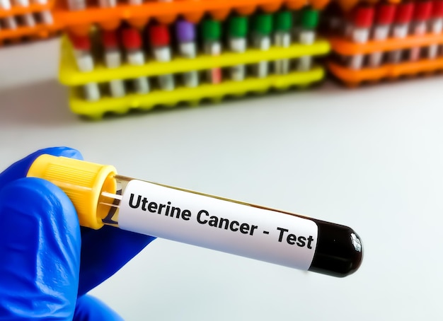 Blood sample for Uterine cancer test CA 125