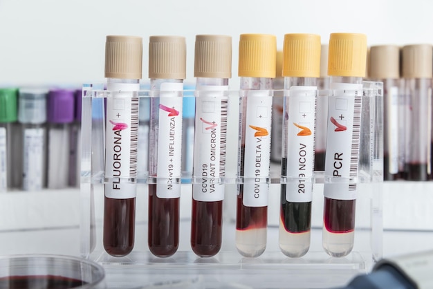 Blood samples of new variant OMICRON plus flu FLUORONE, covid19, coronavirus. Selective approach to the sample tube.