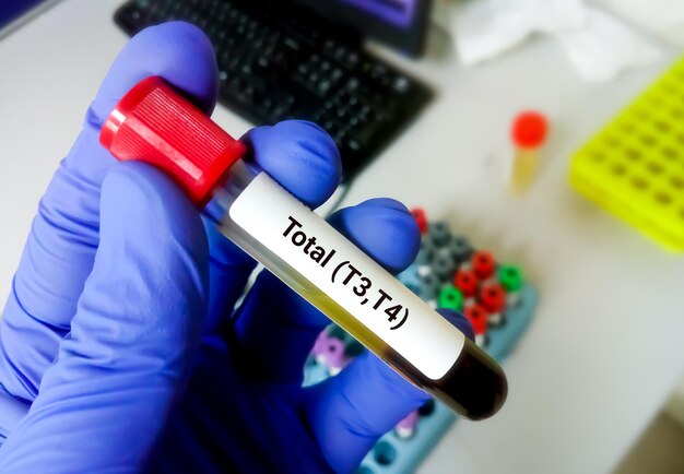 Blood samples for thyroid function testing