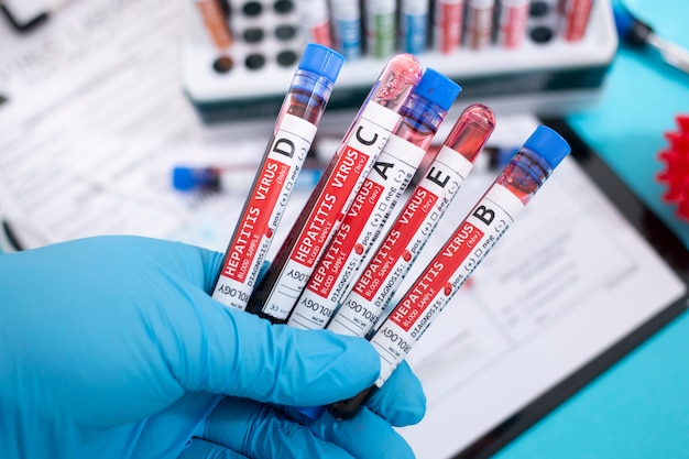 Photo blood samples with infected virus