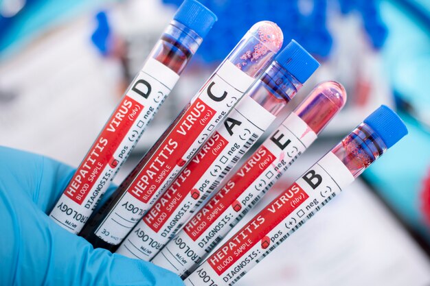 Photo blood samples with infected virus