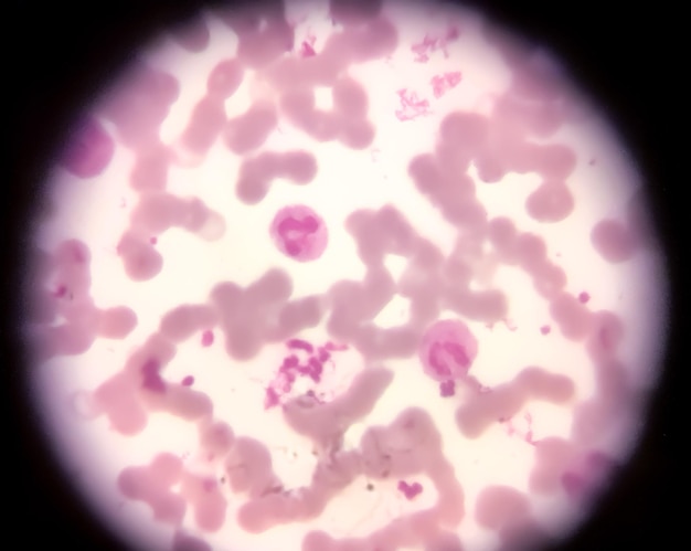 Blood smear microscopic show neutrophilic leucocytosis and thrombocytosis