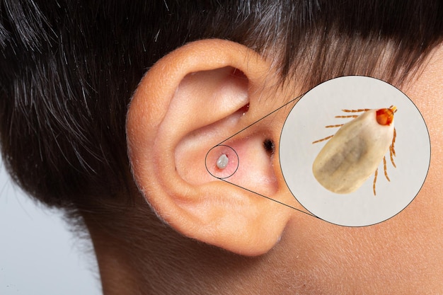 인간 아이의 귀에 붙은 피를 빨아먹는 진드기 위험한 질병 전염의 개념 벡터 곤충 감염의 위험 라임병