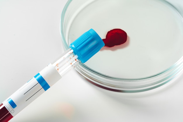 Blood test analysis with Petri dish close up