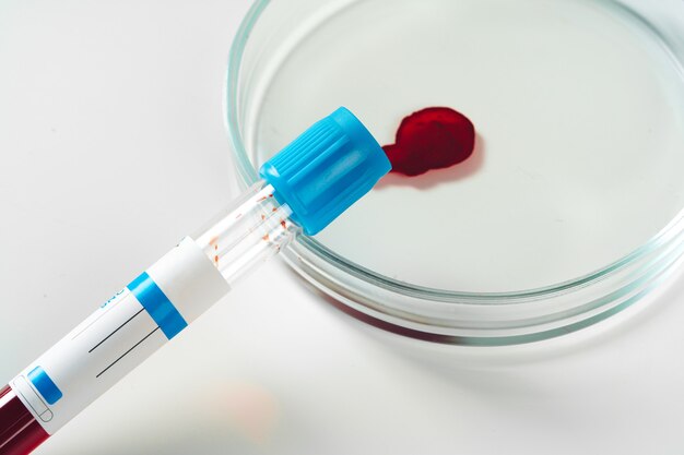 Photo blood test analysis with petri dish close up