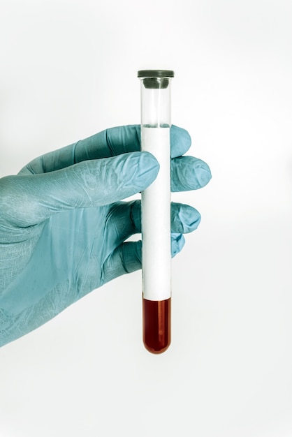 Blood test in a medical test tube in a doctor's hand on a white surface