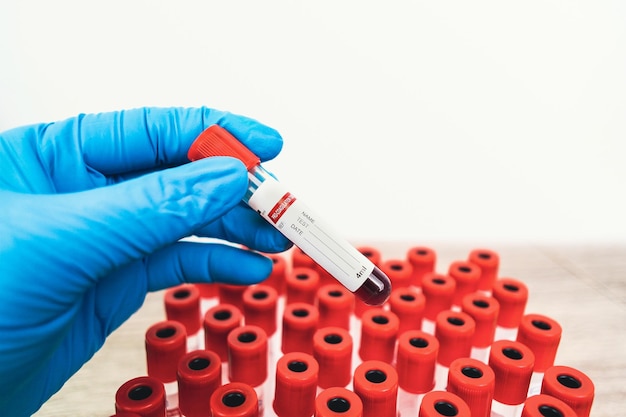 A blood test sample tube with a red cap is in the hand of a blue gloved doctor