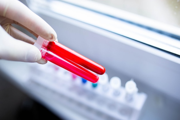 Foto analisi del sangue in una provetta in laboratorio