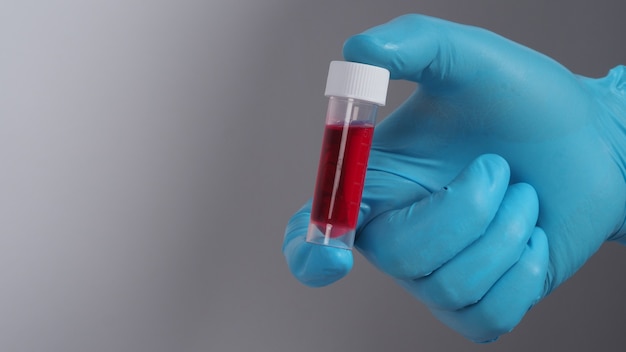 Provetta di sangue. test covid 19. mano del medico che tiene una provetta di sangue per analisi in laboratorio. tecnico in guanti medici che tengono test in provetta di sangue per la ricerca