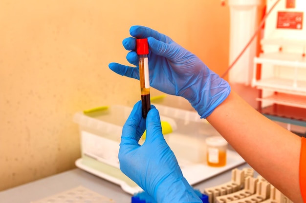 Blood tube in hands. Test for analysis in the laboratory of hematology. Illness diagnosing. Selective focus.