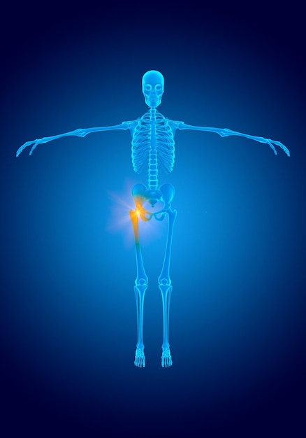 Blue hologram pain in the femur joint caused by cartilage wear