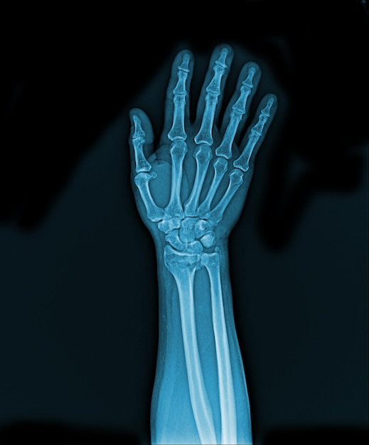 Синий рентгеновский снимок руки с буквой t на ней