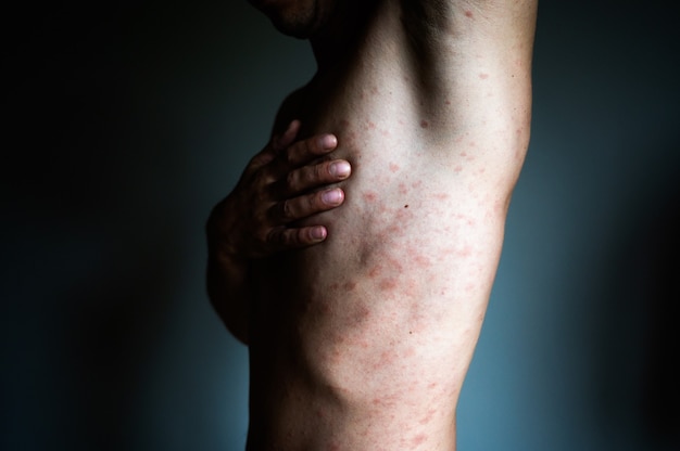 성인 남성의 몸에는 수두나 수두 대상포진 바이러스에서 발견된 붉은 여드름과 거품 발진이 있습니다. 질병 후 의학적 합병증.