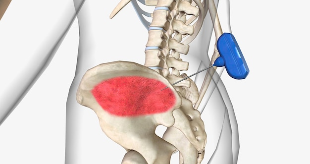 Photo bone marrow biopsy external view