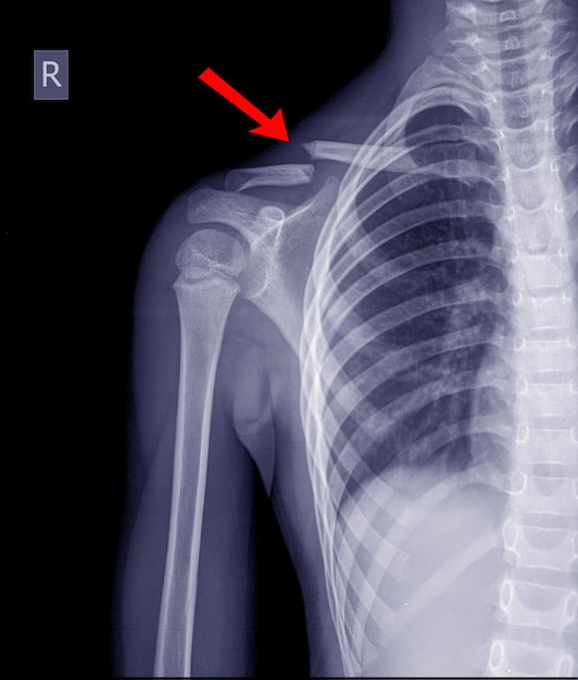 Borst röntgen fractuur rechter sleutelbeen.