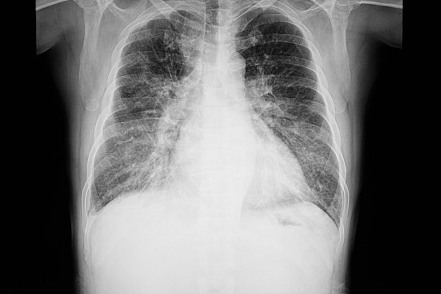 Borst xray film van een patiënt met cardiomegalie