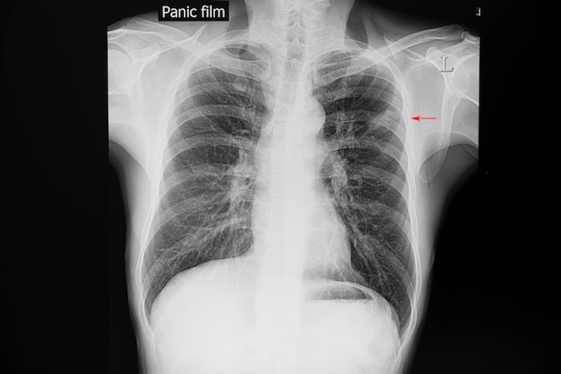 Borst Xray film van een patiënt met tuberculose