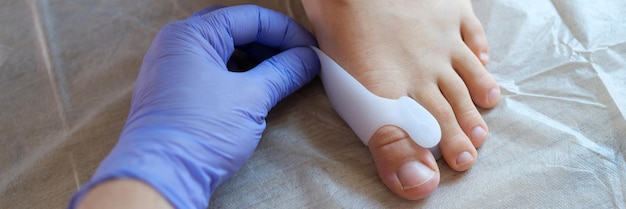 Bovenaanzicht van arts-orthopedist die een beugel aanbrengt voor hallux valgus misvorming van gewrichten van voet en