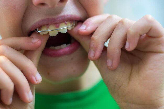 Boy observing dental braces in the mirror