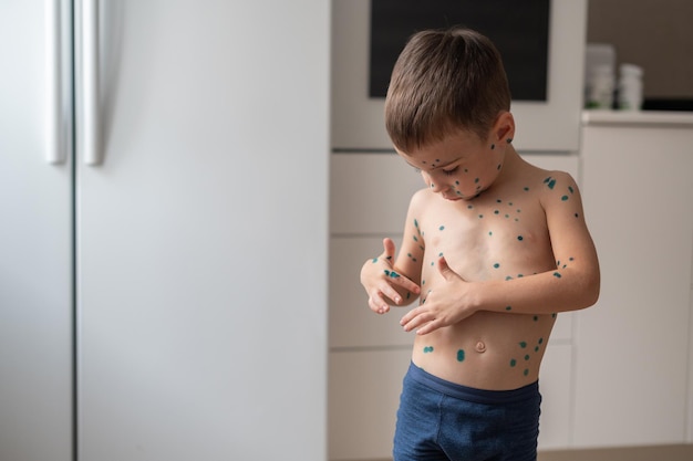 a boy whose face is covered with pimples of chickenpox anointed with green paint