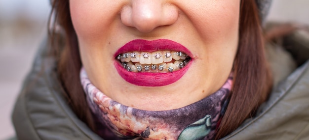 Foto il sistema del tutore nella bocca sorridente della ragazza, la fotografia macro dei denti, il primo piano delle labbra rosse. ragazza che cammina per strada