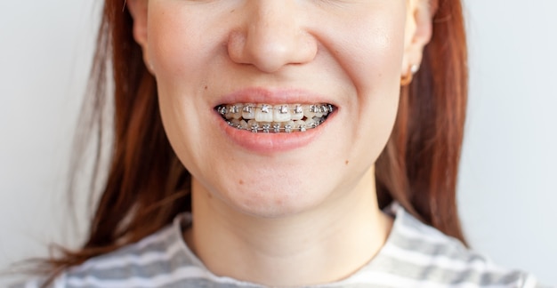 Braces in the smiling mouth of a girl. Smooth teeth from braces.