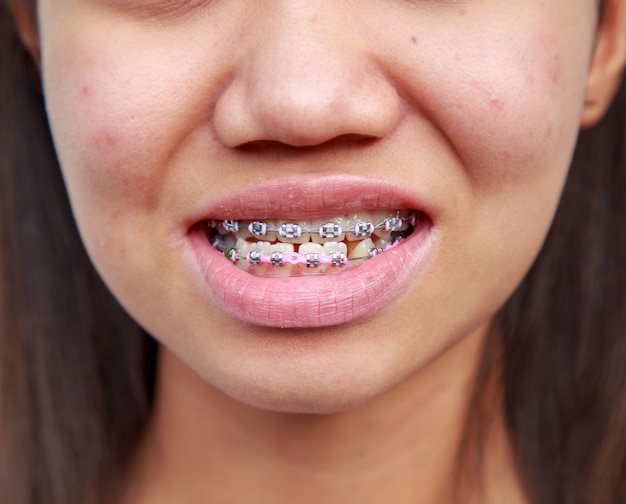 Braces to treat symptoms prognathism 