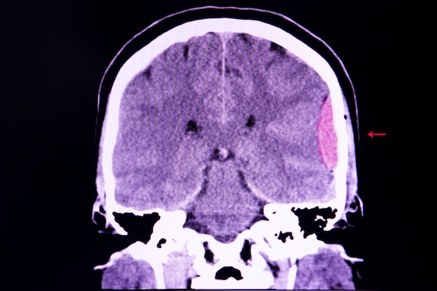 Brain CT scan,  epidural hemorrhage