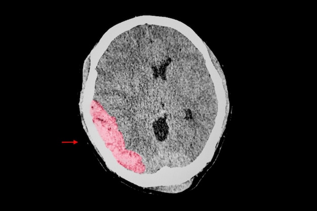 A brain CT scan of a patient with traumatic injury showing epidural hemorrhage