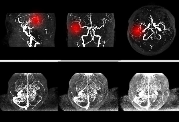 brain stroke x-ray image.