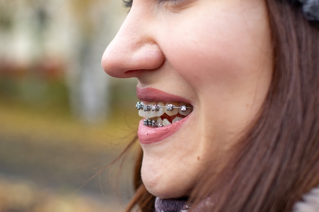 Sistema brasket nella bocca sorridente di una ragazza, fotografia macro di denti, primo piano delle labbra