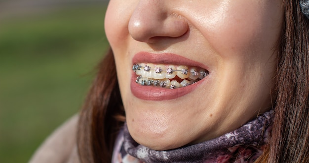 Система браслетов в улыбающемся рту девушки, макросъемка зубов, крупный план губ