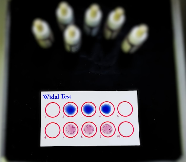 Foto breedtest door middel van agglutinatiemethode om tyfus en paratyfus te diagnosticeren