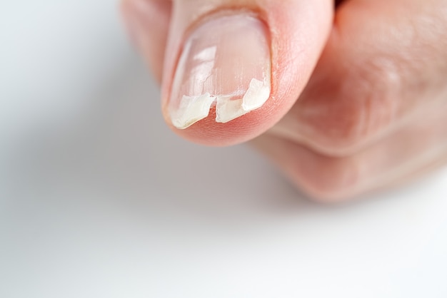 Foto chiodo rotto su una mano femminile. tiro del primo piano di unghia rotta.