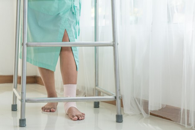 Сломанная нога женщины, шина для лечения травм от переломов костей в больнице.