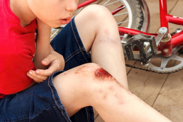 赤いTシャツとデニムのショートパンツで壊れた負傷した膝の子供ヨーロッパの少年が自転車から落ちて、傷の擦り傷を見る子供の夏休み