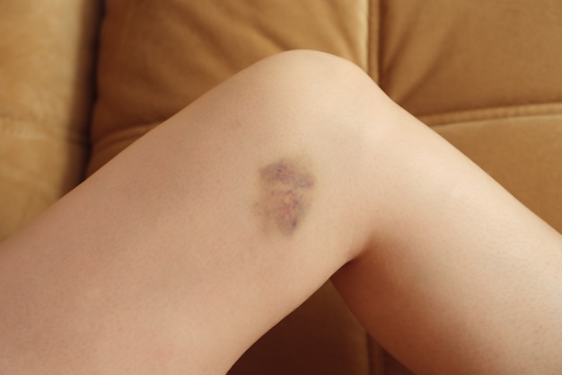 Bruise on the leg of a young woman of clouse up
