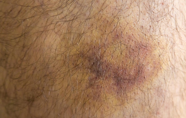A bruise on a man's leg Selective focus