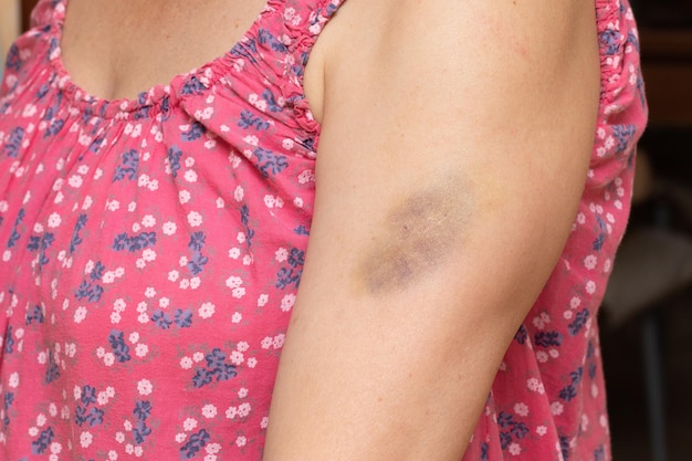 Bruise on a young woman's arm as a symptom of brittle capillaries