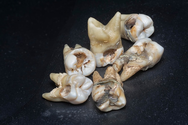 the bundle of unwanted extracted decay human teeth