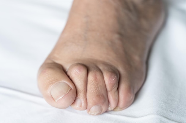 망치 발가락과 건조한 피부가 배경 위에 있는 노인의 발에 있는 Bunion 위생 수술