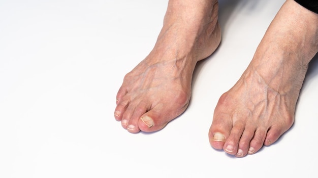 Bunion or hallux valgus on senior woman foot deformity of the\
joint connecting the big toe to the foot skeletal disorder on old\
woman body