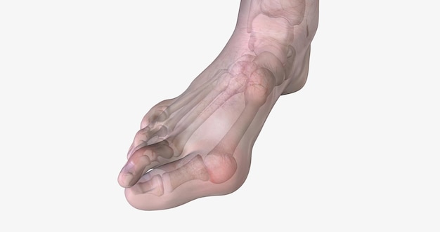 Bunions 및 겹치는 발가락