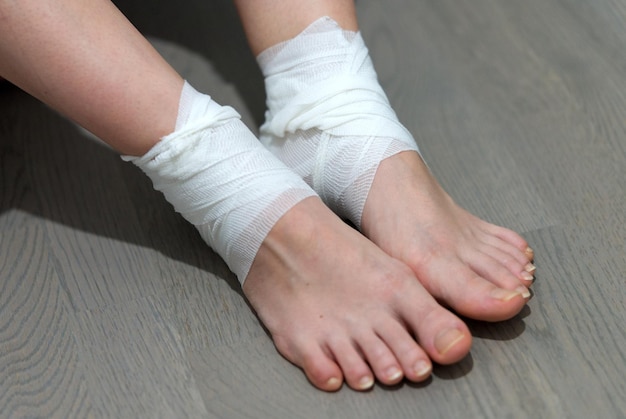 callus on leg girl uses ointment bandaid and bandage to treat calluse